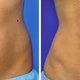 Preoperative frontal view (left) compared to a photograph obtained 6 months postoperatively of a female patient with vertical line etching and defined hip lines (right).